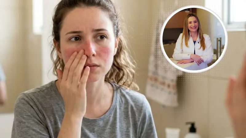 O que é rosácea no rosto? Veja causas e tratamentos